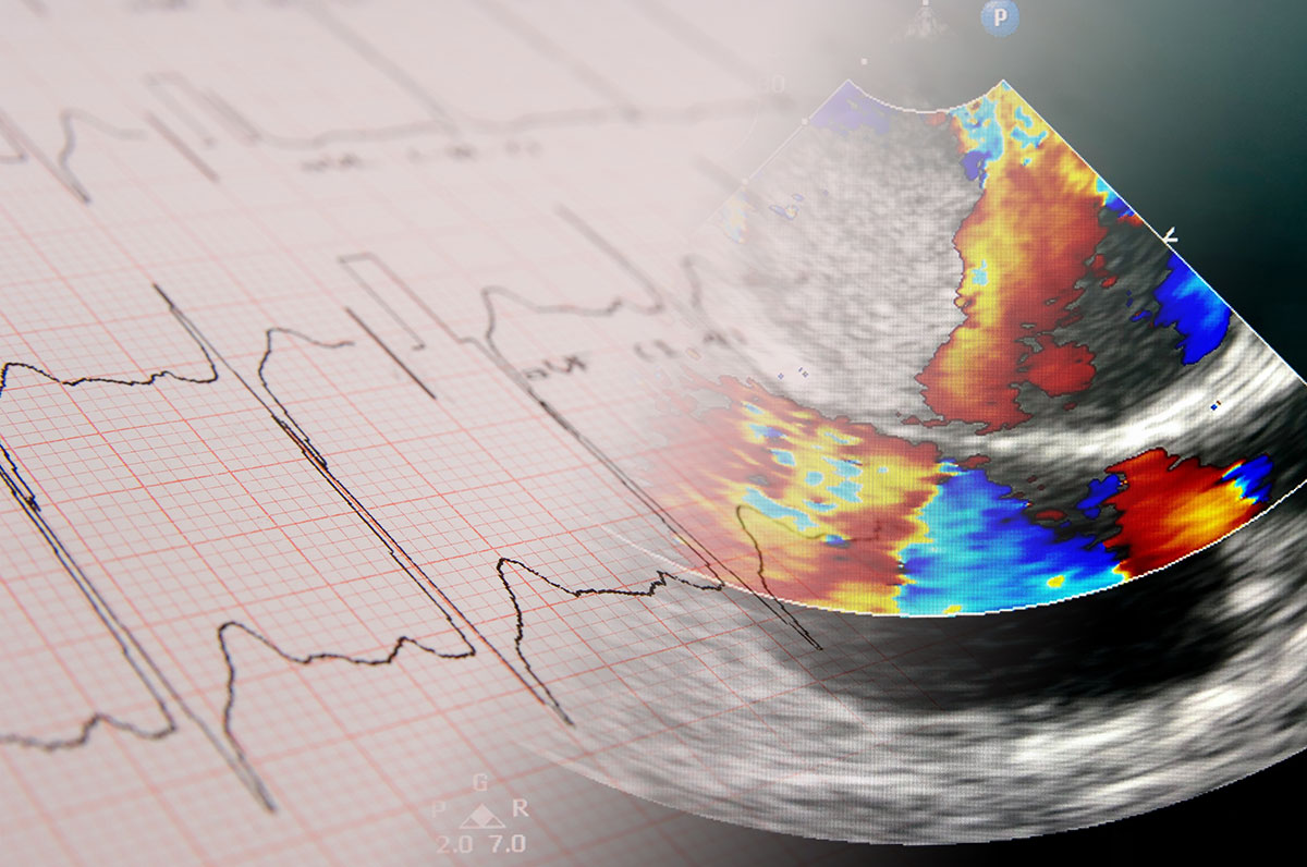 ecg-echo